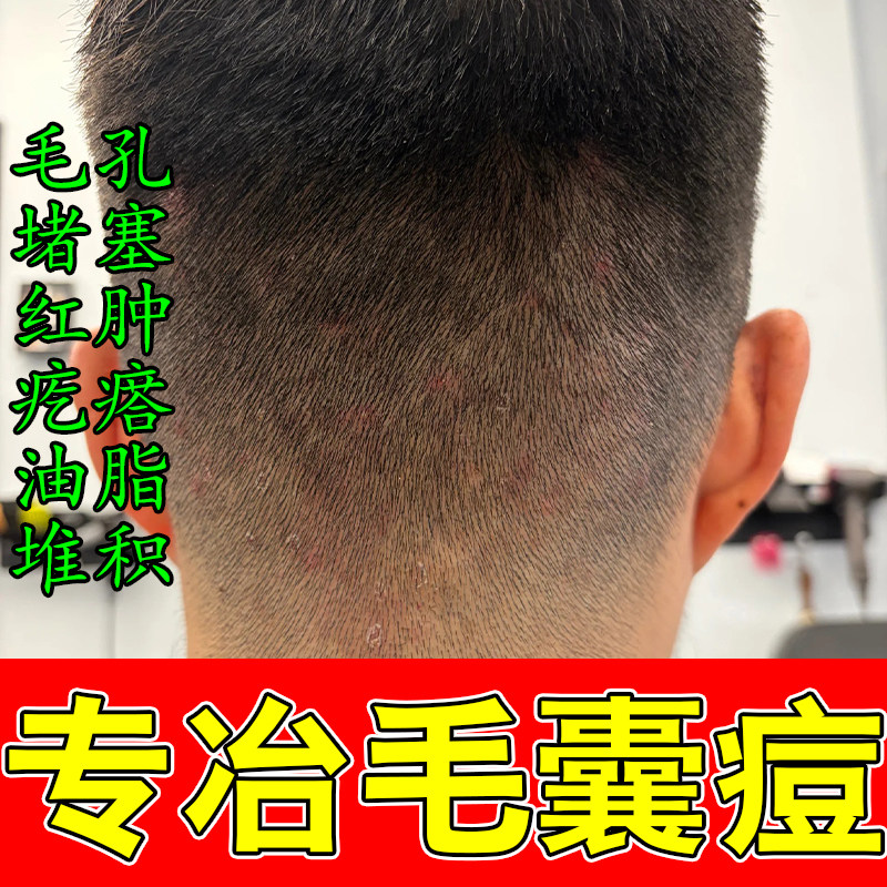 毛囊头部长痘疙瘩马拉色头溢脂性头皮头痒头部头上有痘疙瘩软膏
