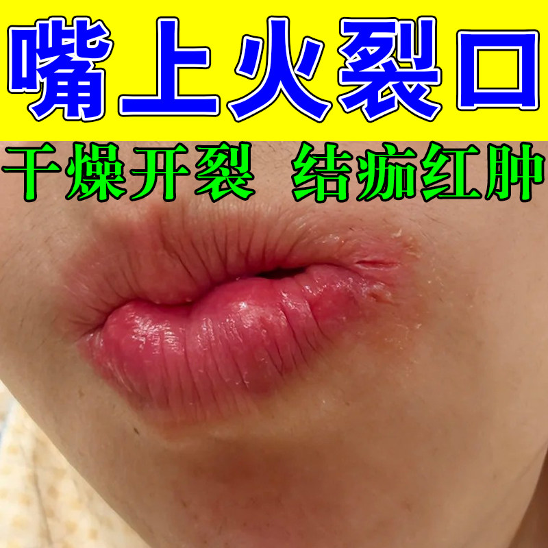 嘴角结痂干裂膏修护唇口角干裂脱皮修复嘴唇红肿起皮修护草木膏