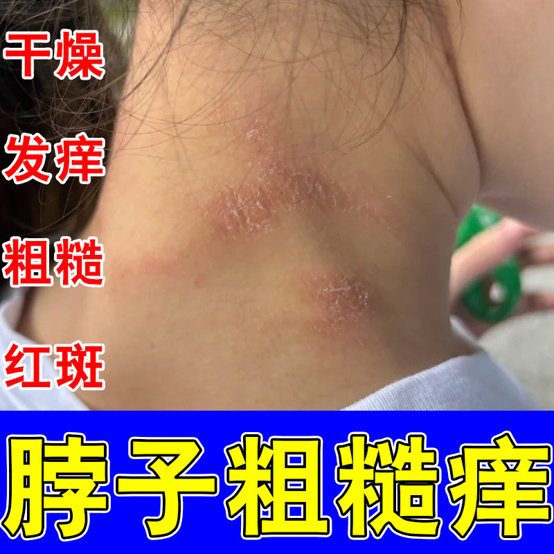 脖子上长红斑皮肤干燥粗糙发痒草本乳膏颈部干燥刺挠红肿皮过敏膏