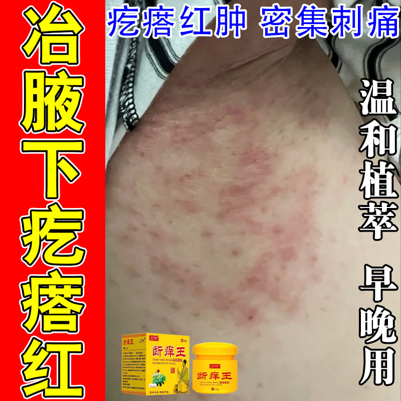 腋下红肿痛胳肢窝干燥粗糙起屑痒红有异味红肿痒疼修护保湿软膏
