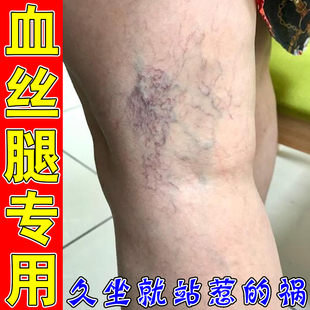 静脉曲张脚上腿上有红血丝毛细血管扩张修复腿部青筋凸起膏