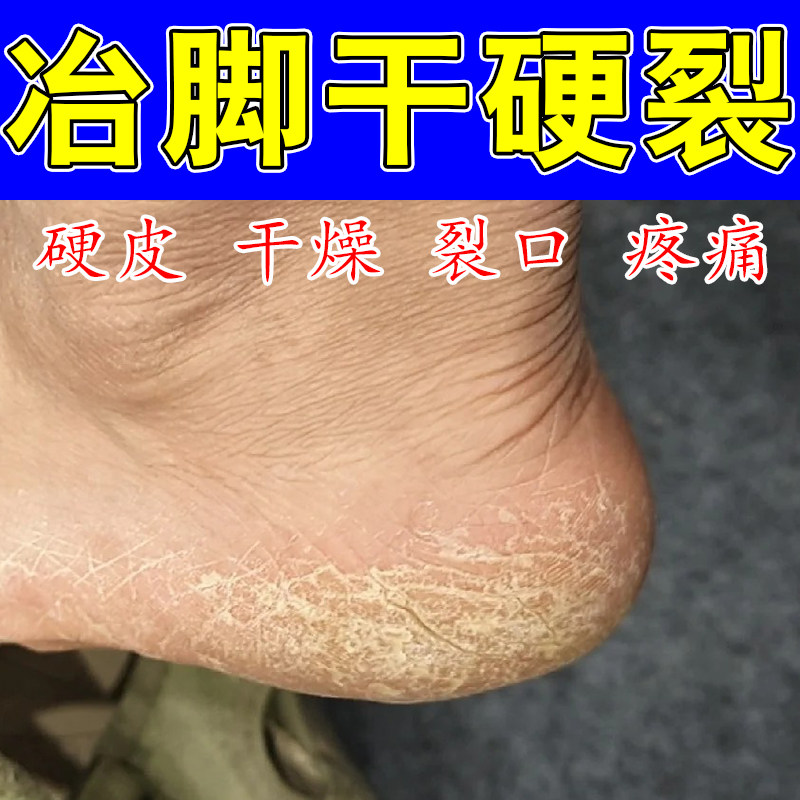 去角化型脚开裂裂口脱皮干燥起硬皮结痂脚后跟干裂开裂口修护膏