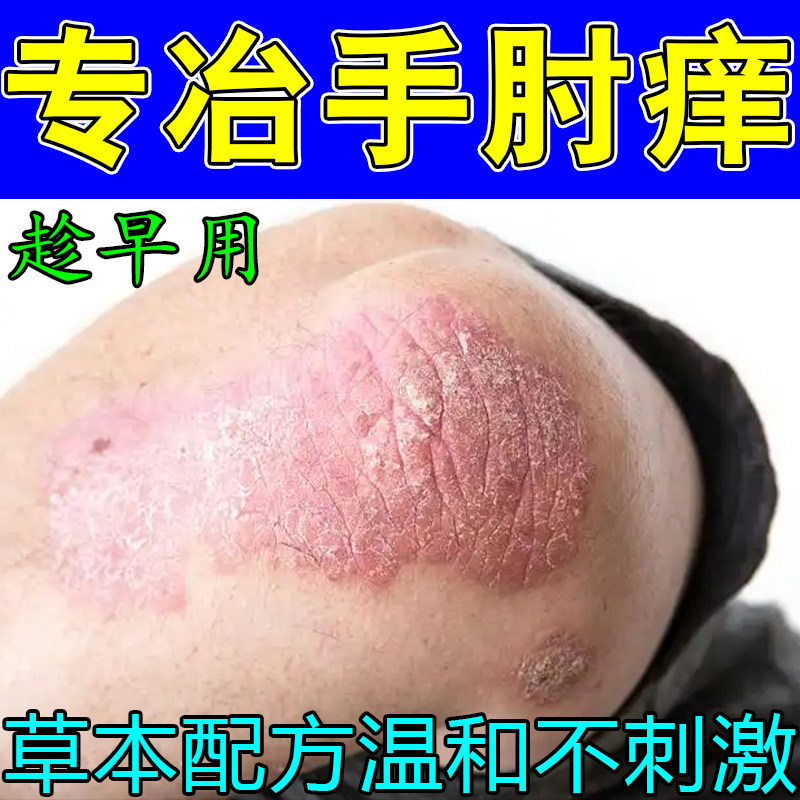 胳膊肘白屑痒手肘粗糙角质增厚关节性粗糙干燥角质神经植萃草本膏