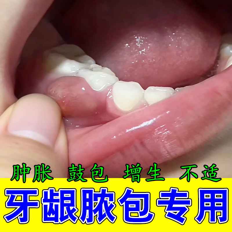 牙龈脓包牙龈起红包流脓肿痛牙龈周牙痛息肉疙瘩草本修护舒缓喷剂