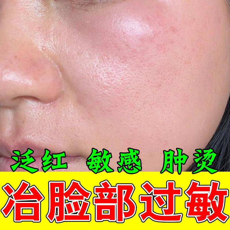 脸过敏激素脸季节型过敏刺痛红肿发痒泛红起皮干燥敏感脸修复膏