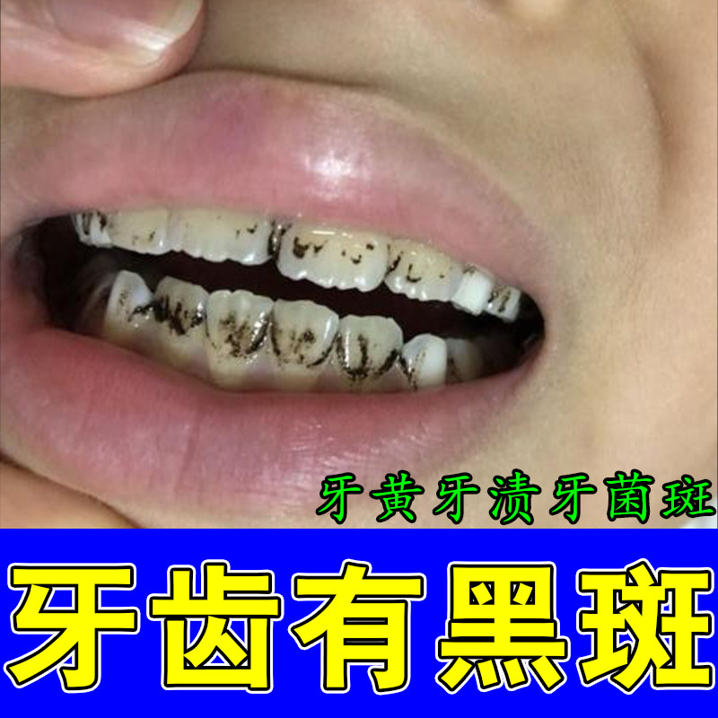 牙根发黑去牙垢牙菌斑牙烟渍牙斑净去牙表面发黑清理斑牙净牙液