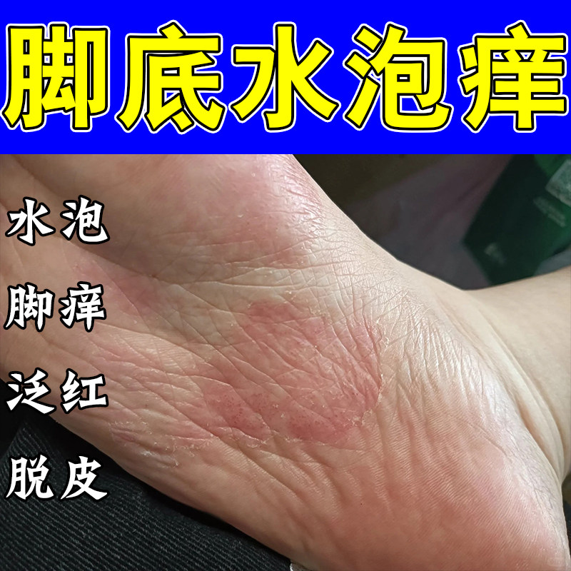 脚底上起小水泡干痒起皮干燥粗糙发痒水泡脚起皮真菌草本软膏