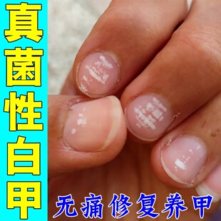 真菌性白甲空甲修复液治手指甲发白长白斑凹凸不平甲床分离修复液
