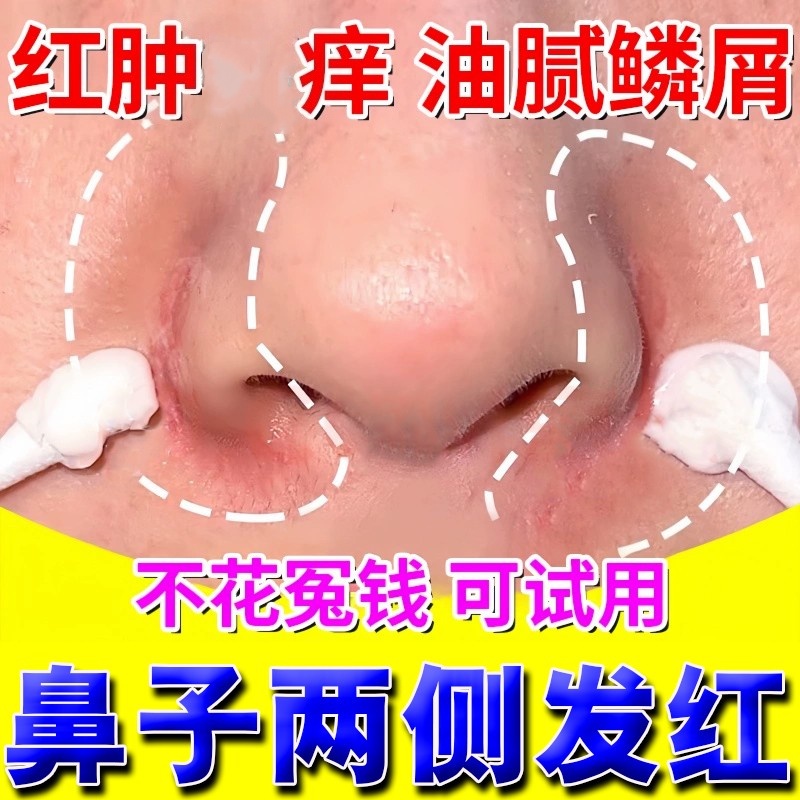 治鼻子两侧泛红脱皮鼻子周围干燥起皮发红干痒修复脂溢性皮炎软膏