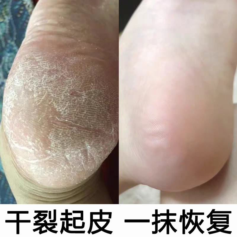 买一送一2瓶装【屈臣氏推荐~护足皴裂凝露嫩滑脚后跟】防干裂手脚