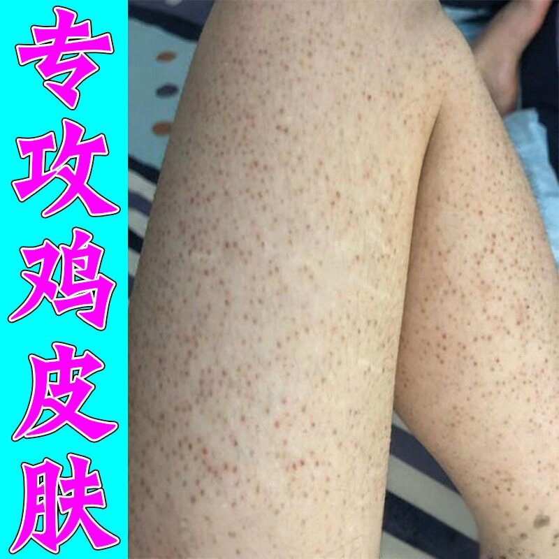 毛周角化症鸡皮肤鸡皮疙瘩毛囊角化小疙瘩粉刺鸡皮肤疙瘩毛囊