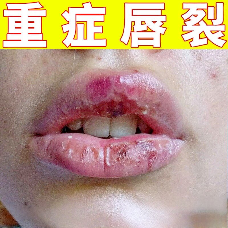 润唇膏唇裂专用嘴唇干裂起干皮脱皮出血修复唇纹去除口角上火泡