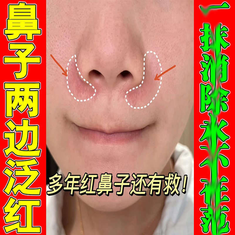鼻子两侧起皮脱皮发红鼻翼两边泛红干燥修复红血丝酒糟鼻专用软膏
