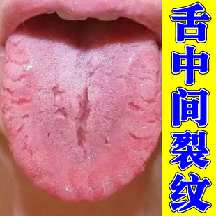 地图舌齿痕舌舌头有裂纹发热灼口综合证口腔发麻调理舌面喷剂
