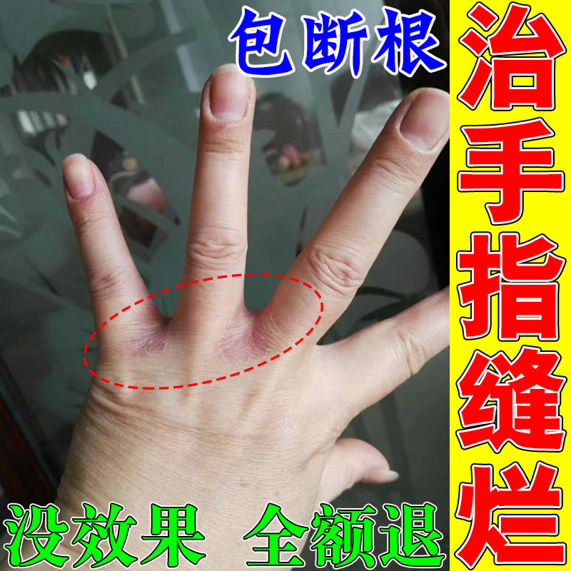 手指缝溃烂膏烂手丫专用治手脚真菌感染指缝脱皮修复膏