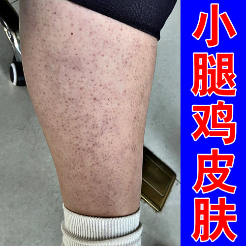 小腿皮肤粗糙红点小腿毛囊角化毛孔堵长疙瘩专用软膏