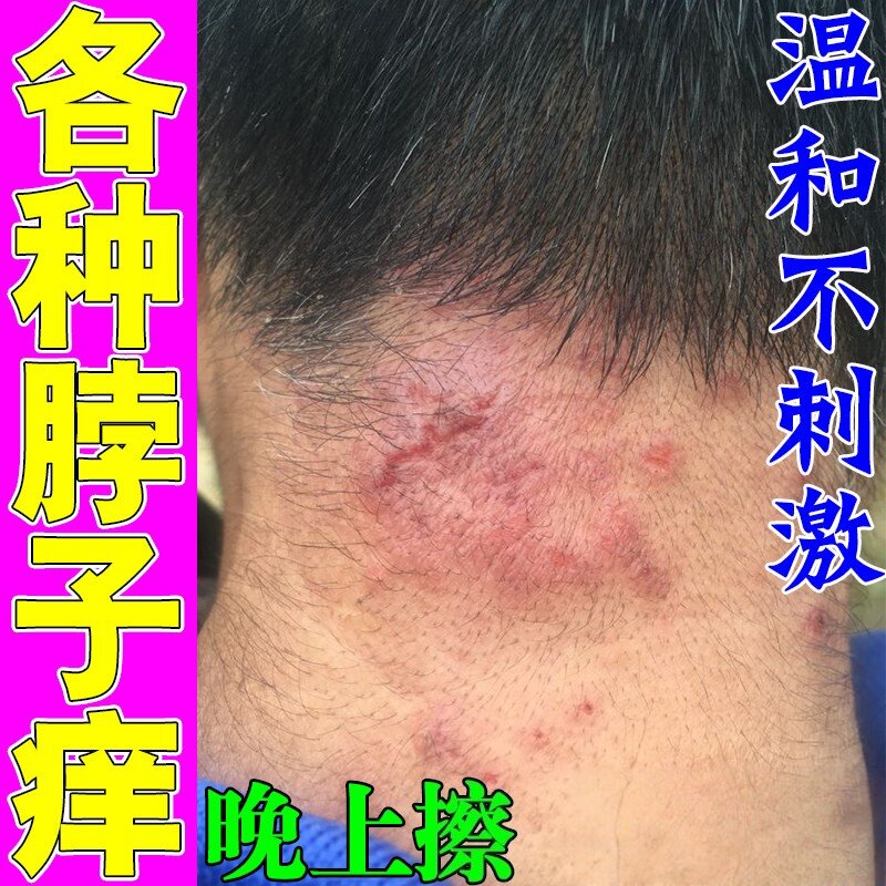 脖子红痒脖子紫外线晒红颈部刺挠痒长红疹发痒干燥脱皮
