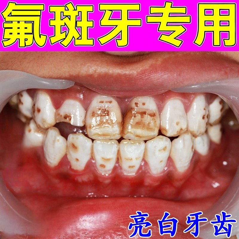 氟斑牙专用牙斑净去除牙黄牙齿牙粉牙釉质牙菌斑牙渍垢洗牙剂