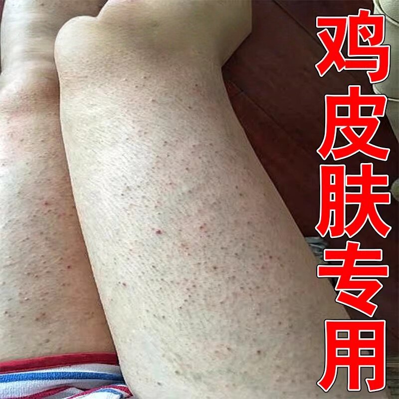 腿上皮肤小黑点全身鸡皮肤疙瘩毛囊角化角质霜果酸男女保湿霜