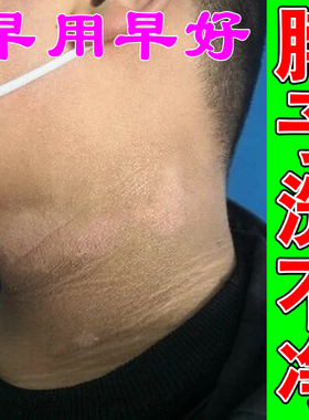 脖子色素沉淀修复脖颈黑色素外用膏颈部黑皮肤外用膏