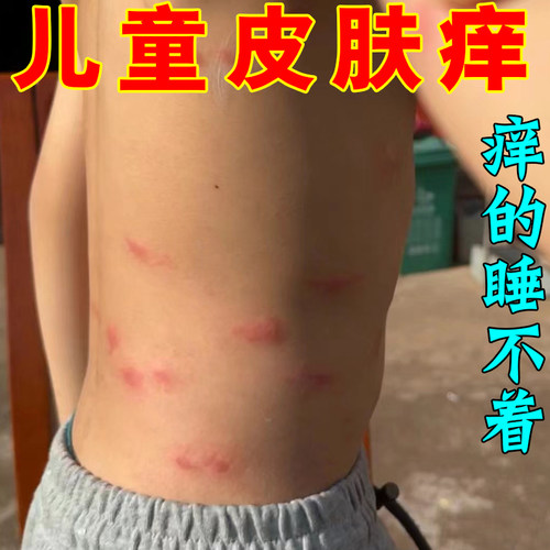 小孩身上干燥痒儿童皮肤起红疙瘩干燥痒专用痒喷雾剂