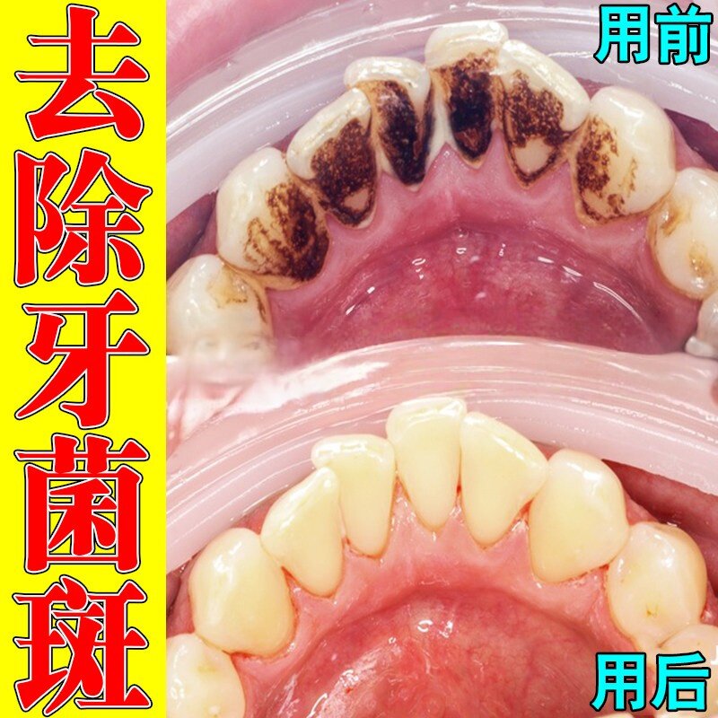 牙斑净牙齿速效黄牙擦掉吸烟茶渍黑牙污垢牙斑菌去除洗牙