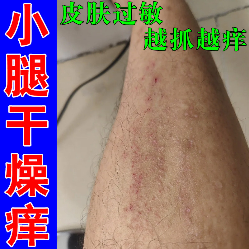 小腿痒皮肤干燥起皮腿上痒挠出小红点红疹外用真菌染/感乳膏