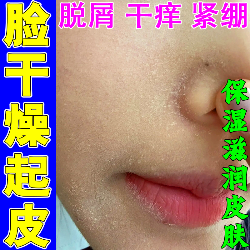 脸干燥粗糙嘴起皮脱皮掉皮有碎屑鼻子下巴起干癣修护擦脸甘油