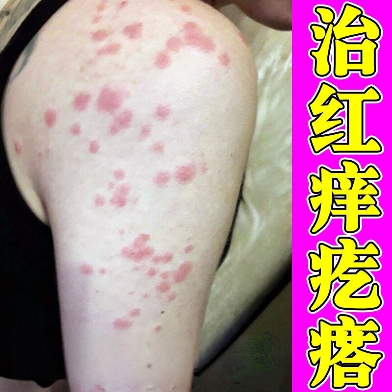 夏天身上起红疙瘩痒成人膏出汗身上痒天热皮肤痒红疹热毒