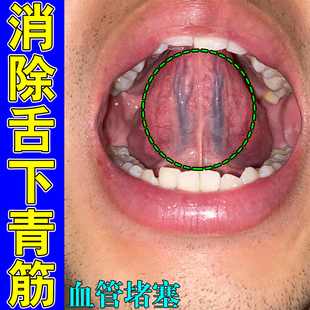 舌下青筋又黑又粗大淤血疏通舌头底冷黑紫血管严重怒张增生一喷灵