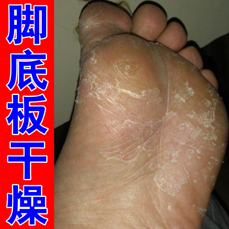 脚底板起皮硬皮剌床单脚底干燥粗糙草木软膏