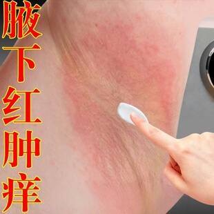 腋下出汗疼痛淹疼红肿长小疙瘩腋窝淹红有异味胳肢窝痒疼特效膏