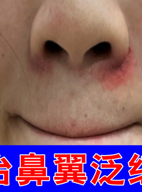 鼻子两侧发红脱皮掉皮痒油腻鼻翼两边泛红干燥起皮鼻头发红专用膏