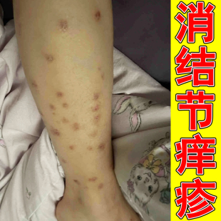 结节性痒疹膏全身皮肤痒痒小腿起红疙瘩红斑专用乳膏