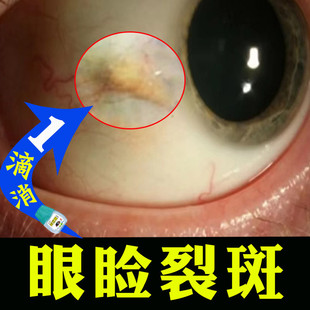 消眼睑裂斑草本眼药水眼白有黄色凸起斑块干涩红有异物感去黄专业