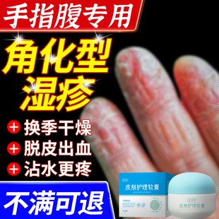 手指腹角化型湿疹手癣膏脱皮干裂真菌感染慢性角质化皲裂性手部XP