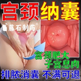 宫颈纳氏囊肿药宫颈肥大囊肿宫颈囊肿的药糜烂肥大宫颈纳氏XP