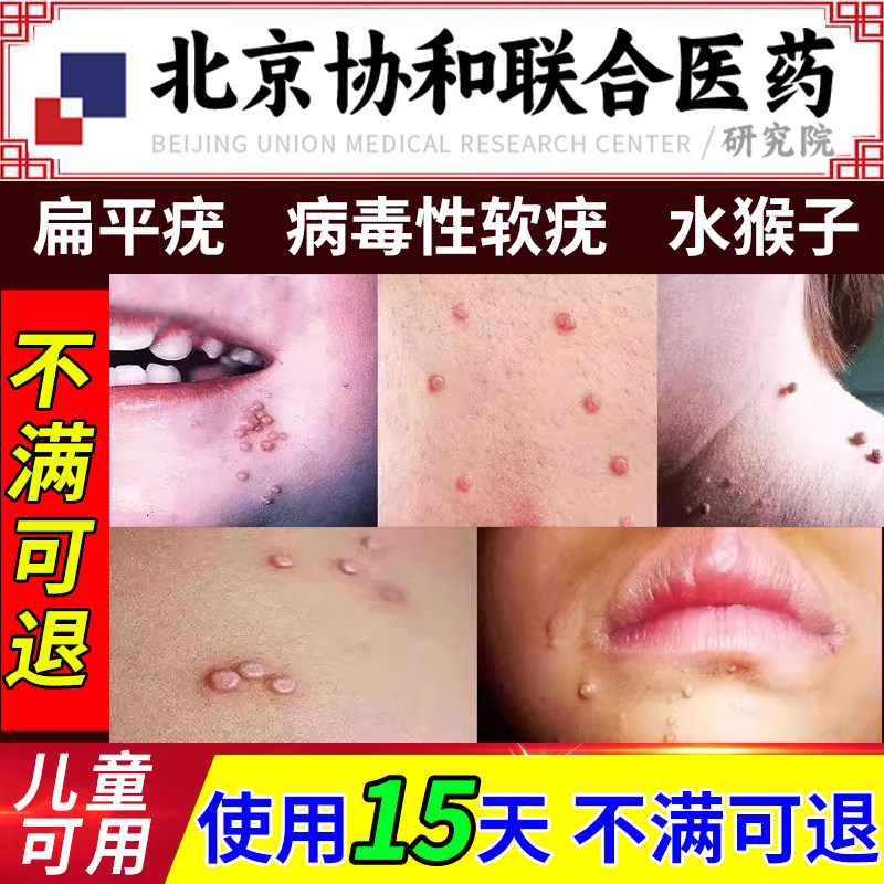 病毒性传染性软疣儿童水猴子软尤药膏祛除病毒医用镊子夹子疣液sg