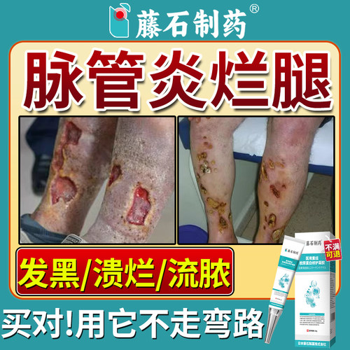脉管炎老烂腿伤口愈合专用膏