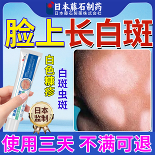 白色糠疹可搭药膏儿童脸上长癣长白斑汗斑桃花癣皮肤瘙痒膏XP