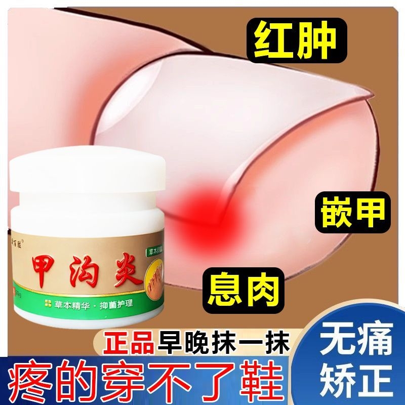 甲沟焱脚指甲疼大拇指往肉里长销肿感染发焱红肿化脓脚指甲止痛膏