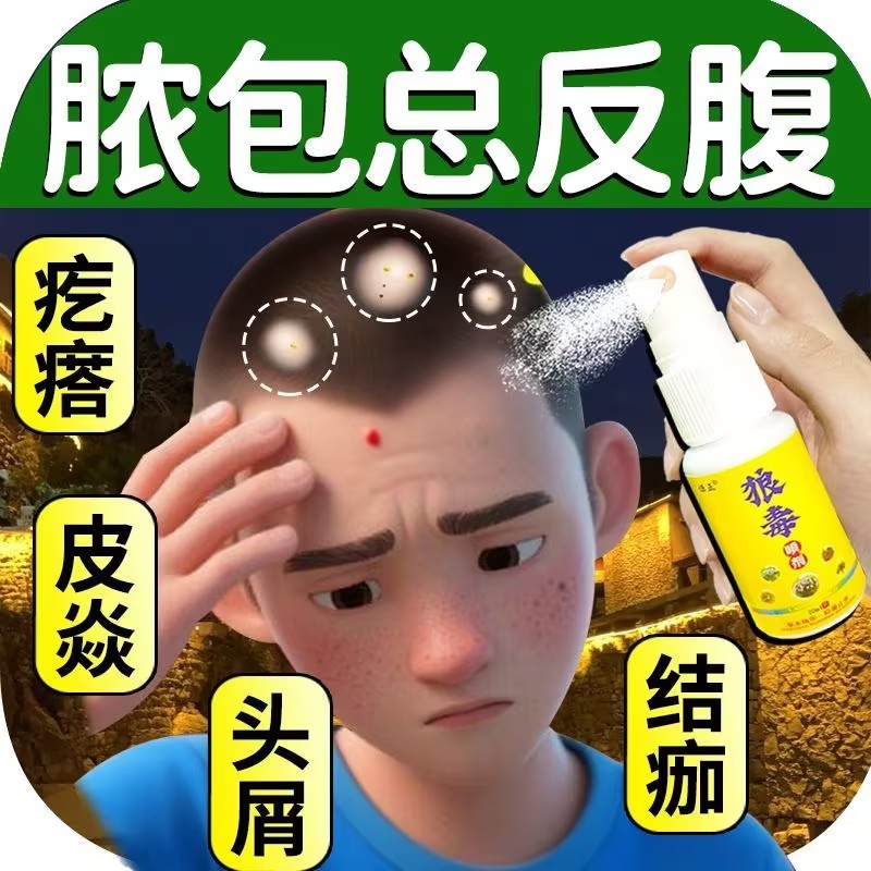 狼毒头藓头皮屑头皮痒头皮发红长疙瘩红斑狼毒喷剂头藓头皮藓