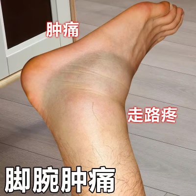 脚踝肿大疼痛专用鼓包骨裂陈旧老伤关节肿大韧带拉伤