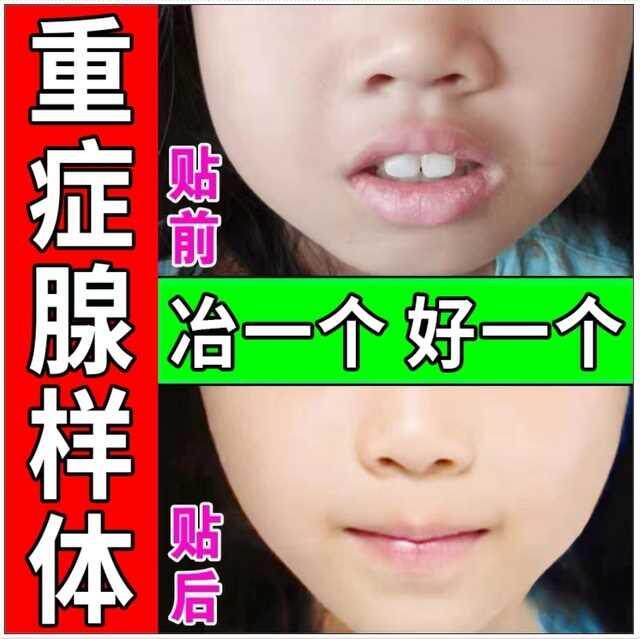 极速腺样体肥大面容矫正器儿童鼻子E不通睡觉打呼噜张口呼吸嘴突