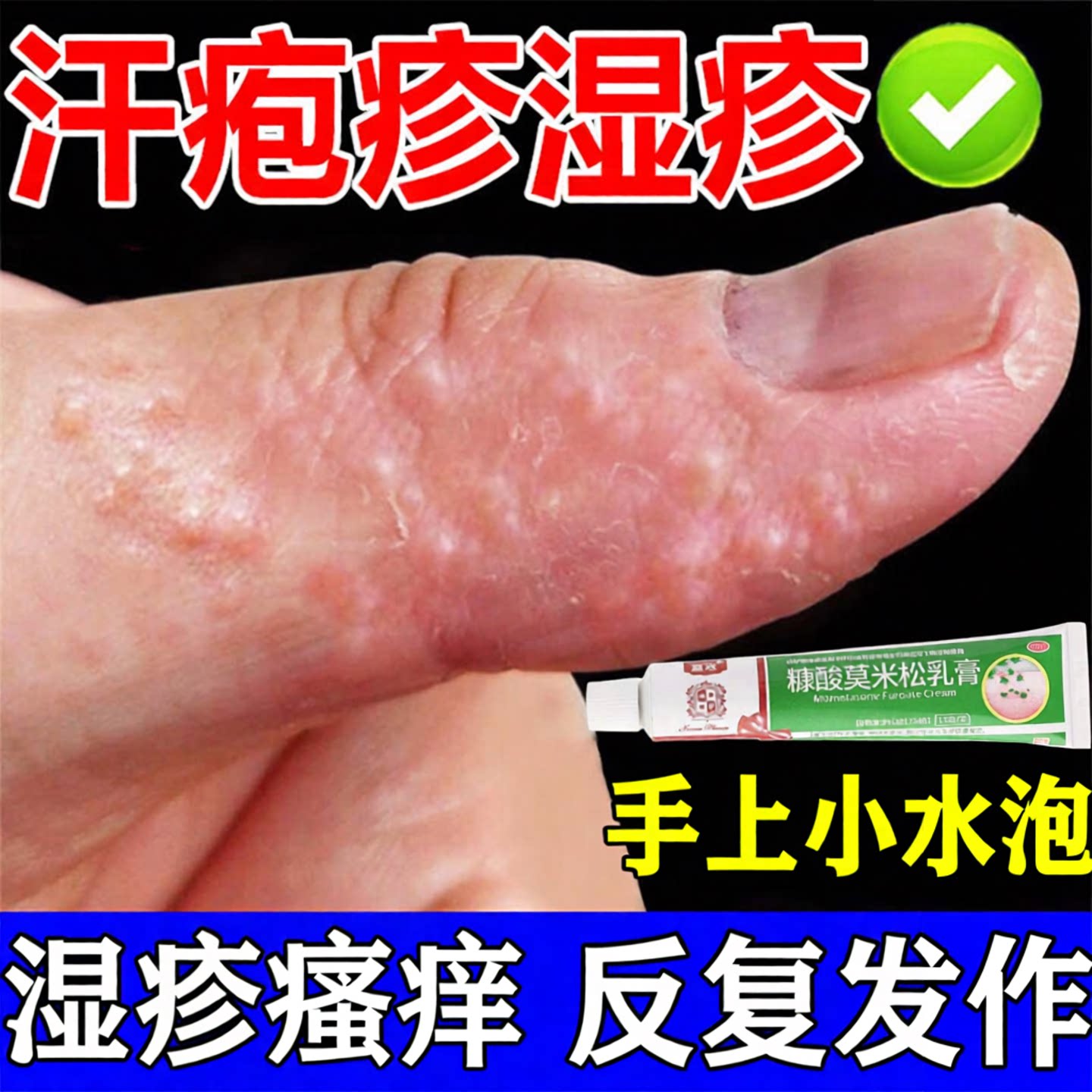 汗疱疹手痒手上起小水泡汗状疱疹止痒汉状真菌感染去专用药膏特效