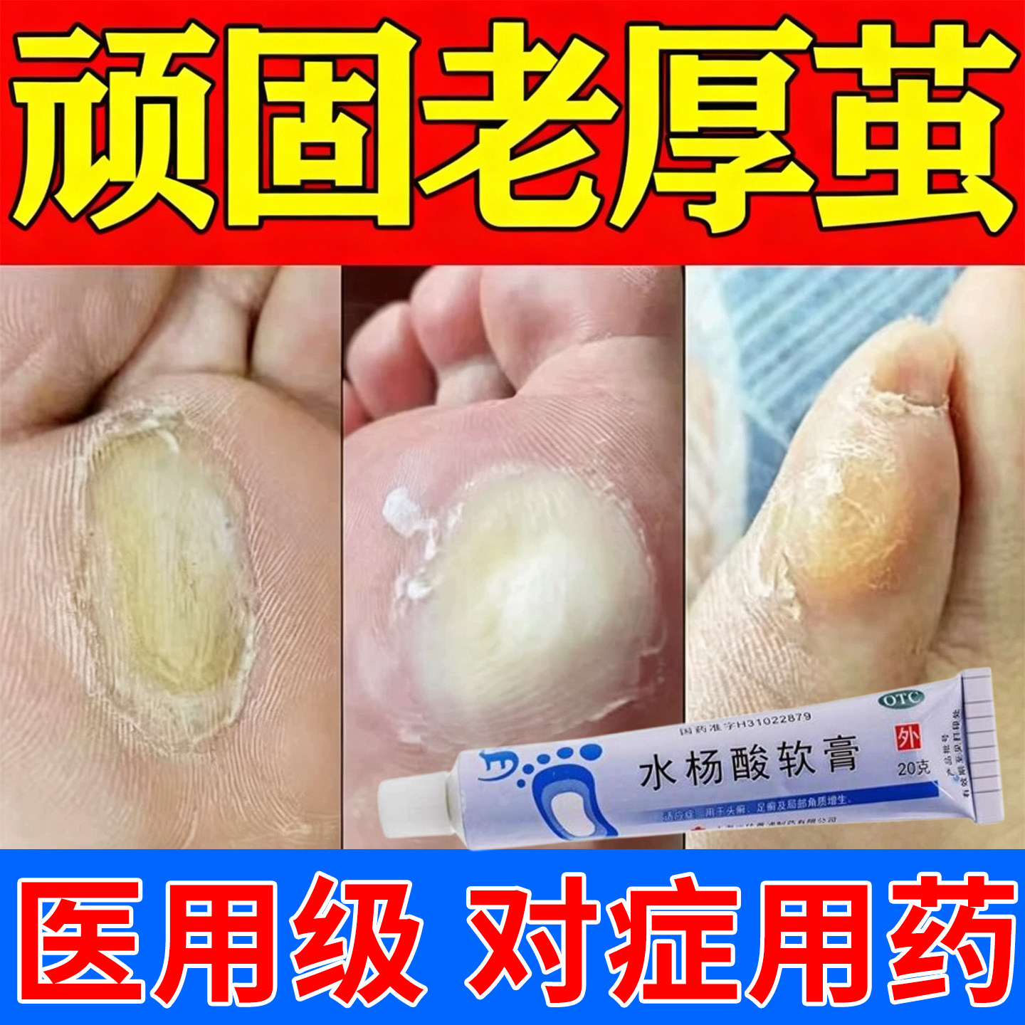 水杨酸软膏正品脚去死皮老茧鸡眼软化药脚钉祛除膏去脚底脚趾老茧