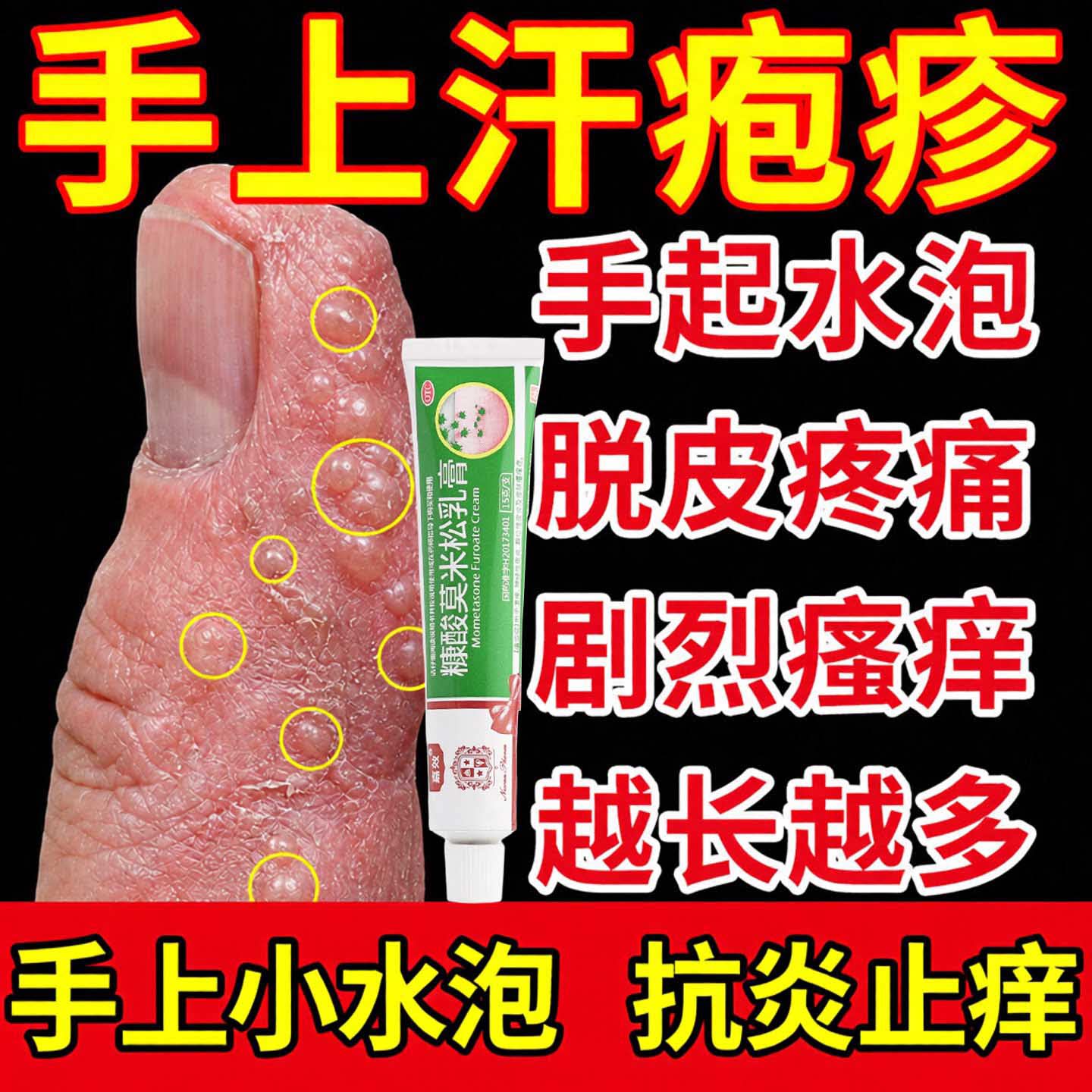 汗疱疹止痒去专用药膏医用级手上起小水泡汗状疱疹真菌感染特药效