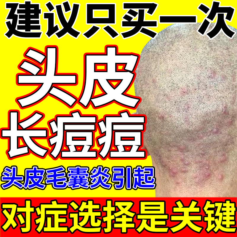藤石制药头上长痘痘皮脂溢性皮炎毛囊炎头部特专外用洗发水去屑VP