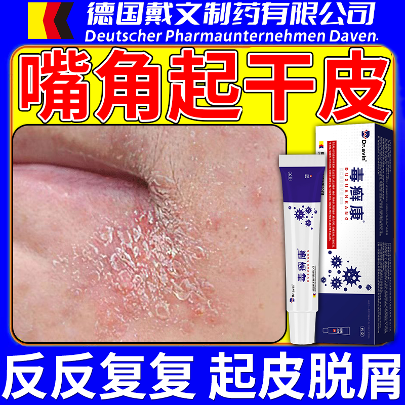 嘴角干燥起皮口周皮炎毒癣康药监备案乳膏癣泛红有碎屑脂溢性皮VP