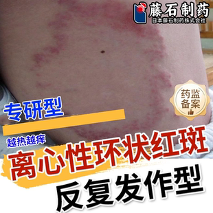 离心性环状形红斑大腿小腿止痒断铜钱癣专外用体癣根药监备案VP